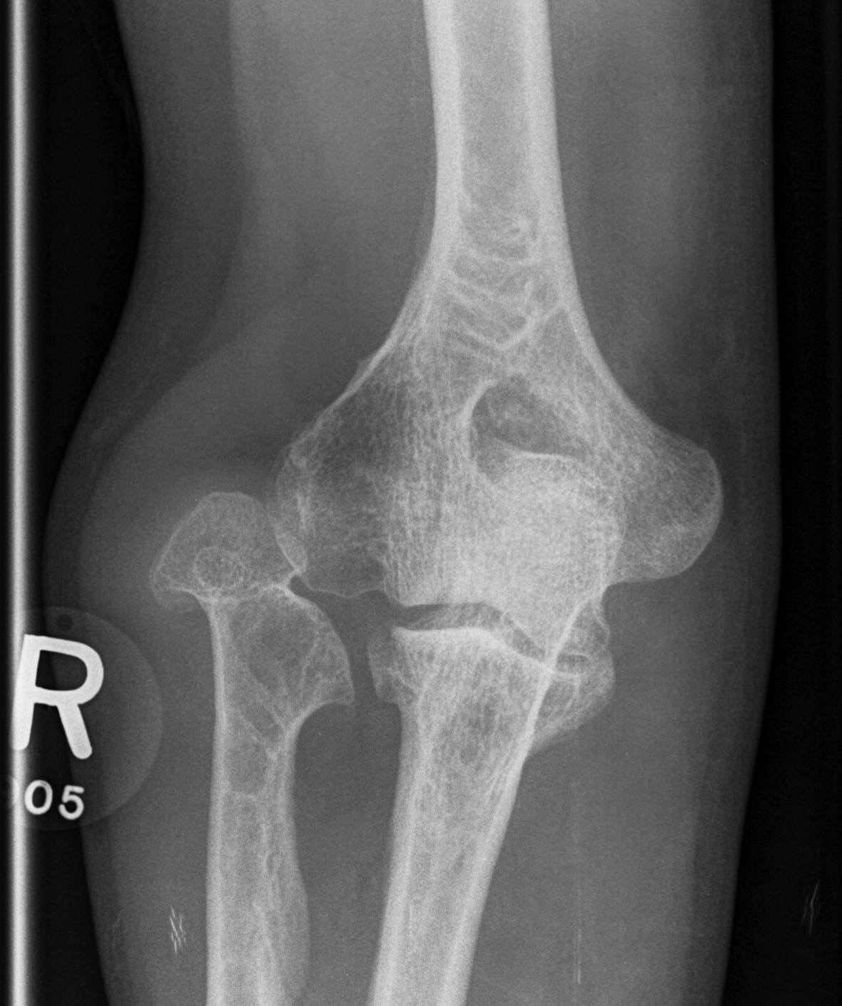 Osteochondroma Elbow